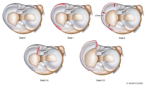 Classification of meniscus extrusion and tear, MTL and MMPR grading system