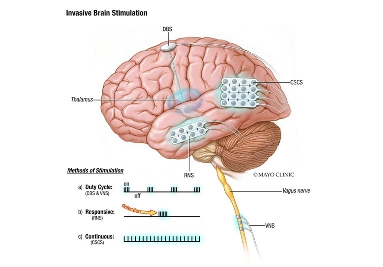 Vagus nerve stimulation - Mayo Clinic