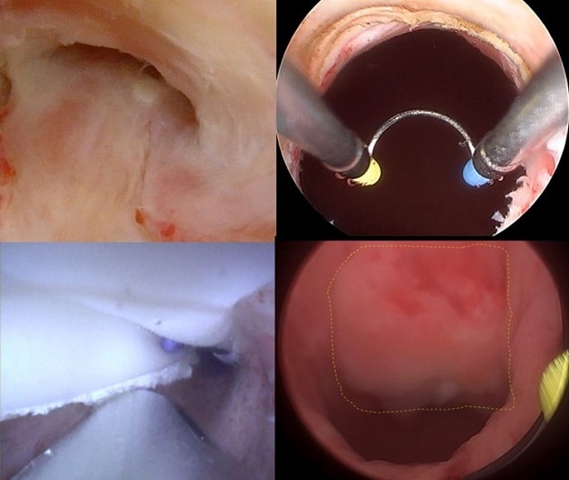 Endoscopic buccal mucosal grafting