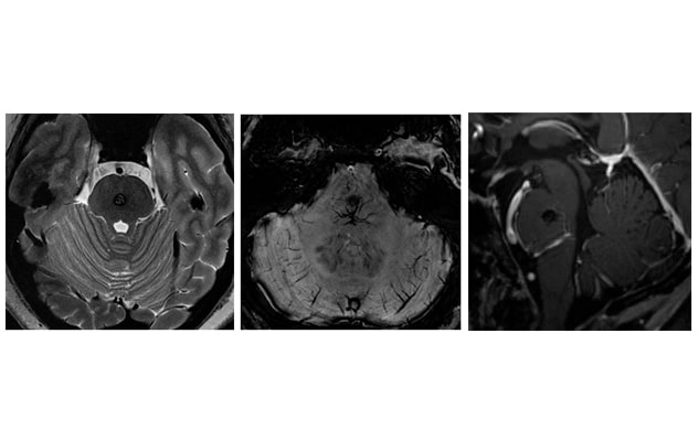 Cavernous malformation on 7T MRI