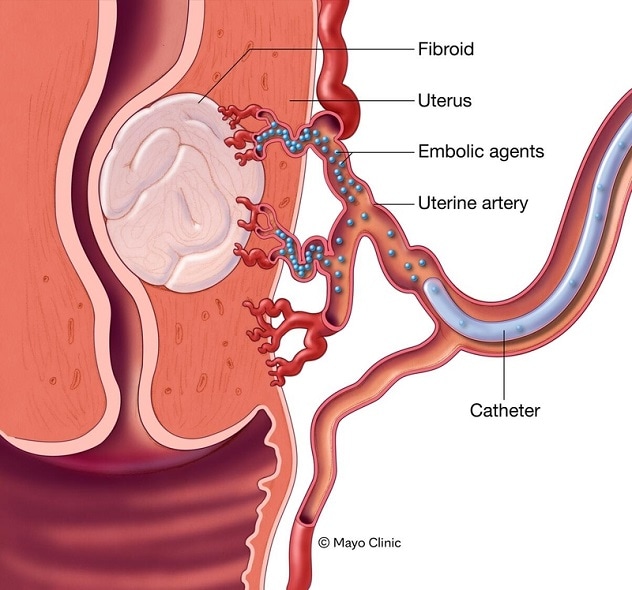 Embolización de las arterias uterinas