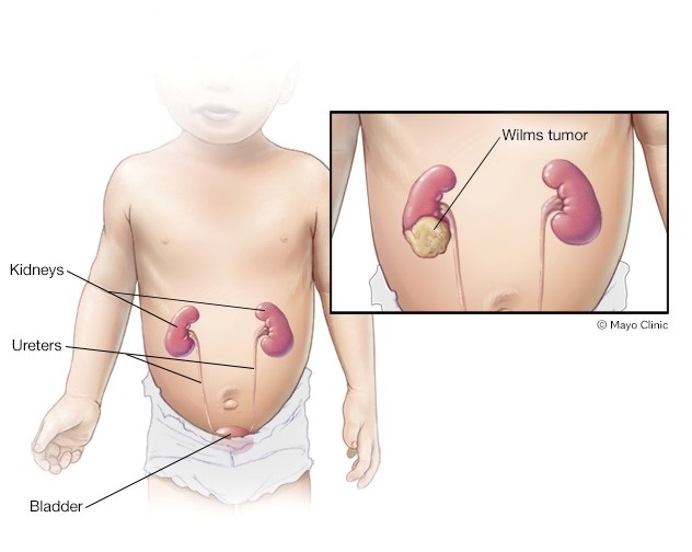 Tumor de Wilms en un riñón