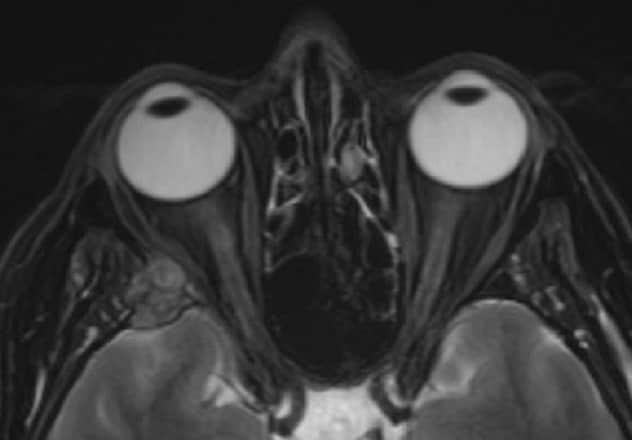 MRI image