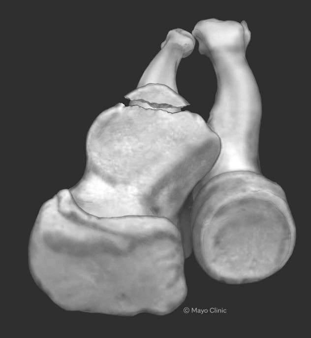 冠状突的骨折模式