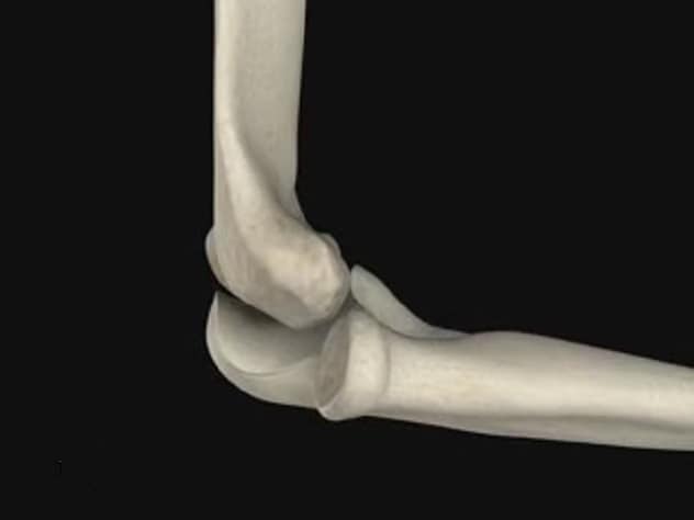 Elbow dislocation