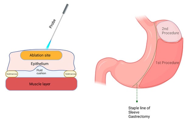 Gastric mucosal ablation and sleeve gastrectomy