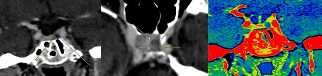 Corticotroph adenoma on new CT modality