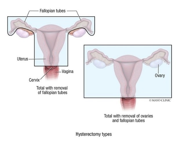Hysterectomy types