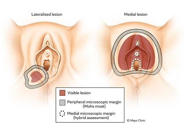 Vulvar lesions