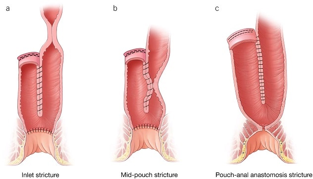 Structural pouch disorders — Strictures