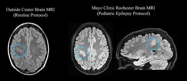 Optimized epilepsy protocol