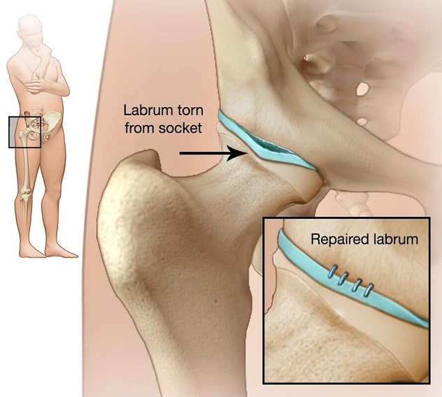 Labral tear in hip and repaired labrum