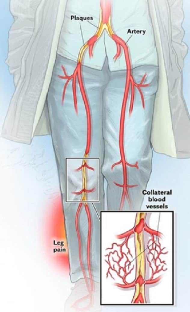 Femoral artery pain online