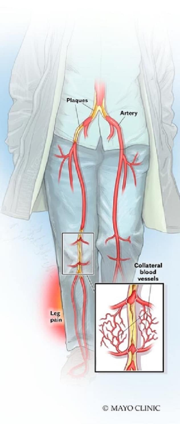 Leg pain from PAD