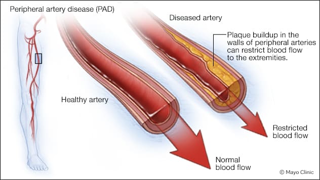 Peripheral artery disease