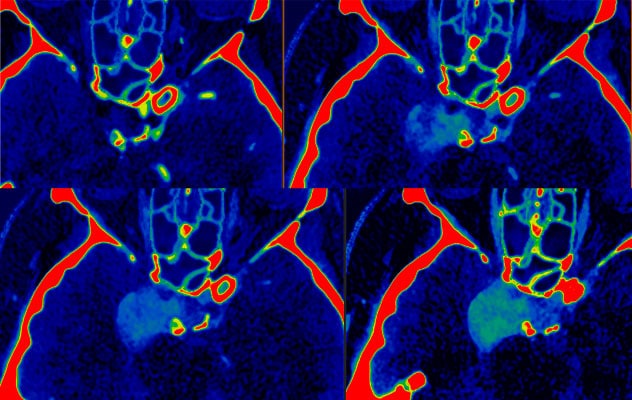 Tumor identification