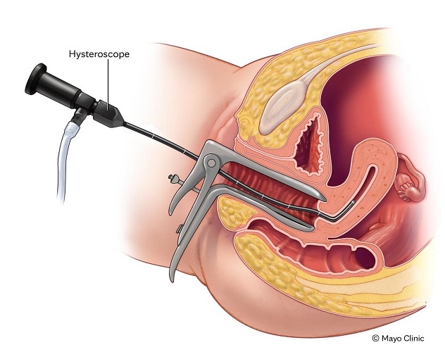 Asherman syndrome diagnosed with hysteroscopy