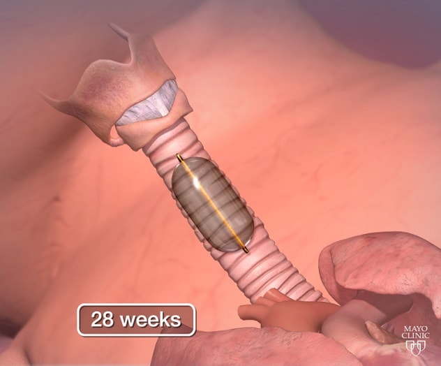 Fetal endoscopic tracheal occlusion (FETO) at 28 weeks