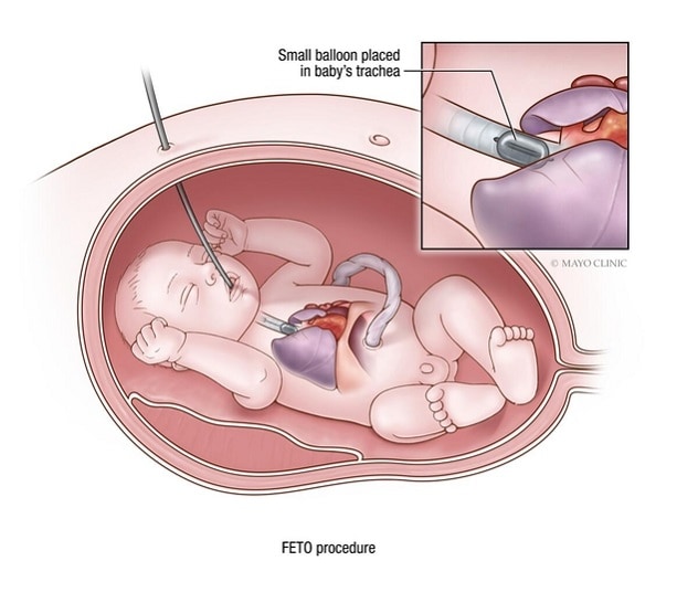 Congenital diaphragmatic hernia