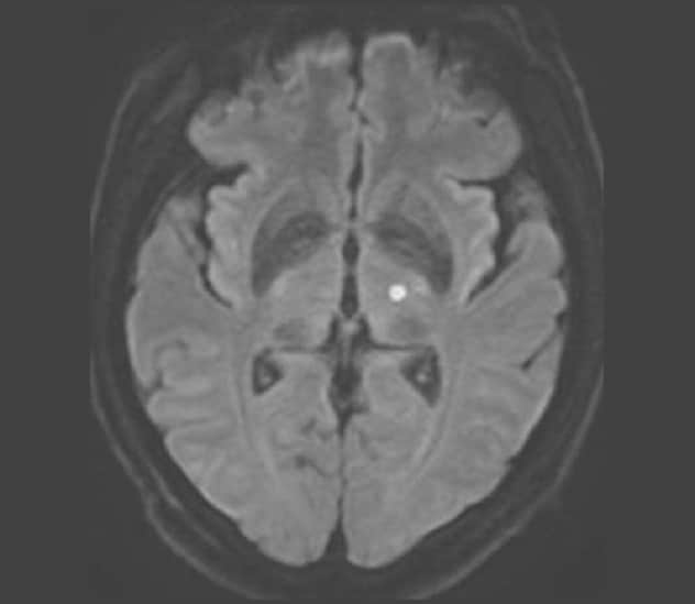 Advanced imaging for tremor treatment