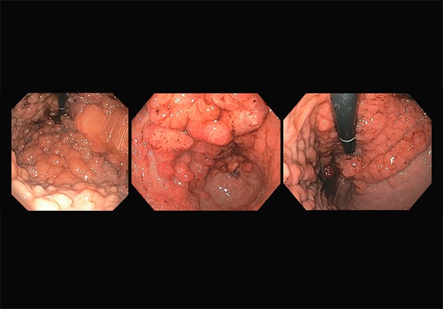 Endoscopic images of innumerable polyps within the stomach