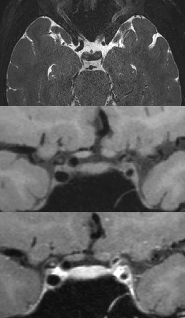 T2-weighted MRI