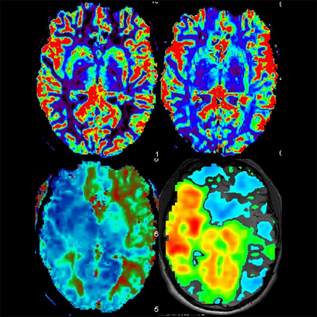 MRI perfusion imaging