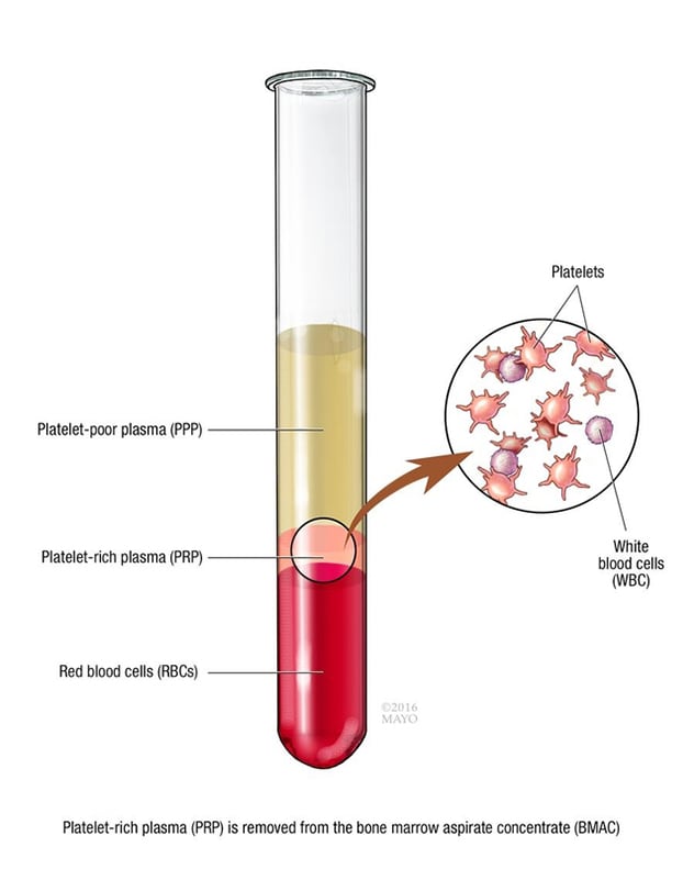 Platelet-rich plasma (PRP) injections to treat knee osteoarthritis