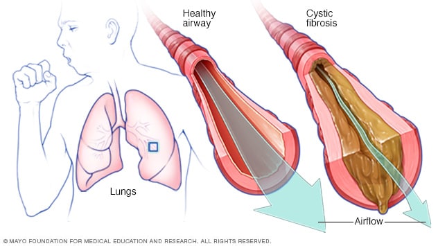 cystic fibrosis lungs diagram