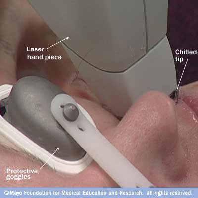 Laser hair removal Mayo Clinic