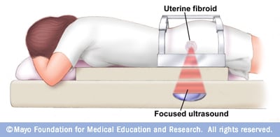 Cirugía con ultrasonido focalizado 
