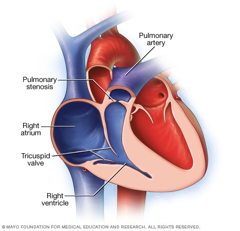 Pulmonary stenosis - Mayo Clinic