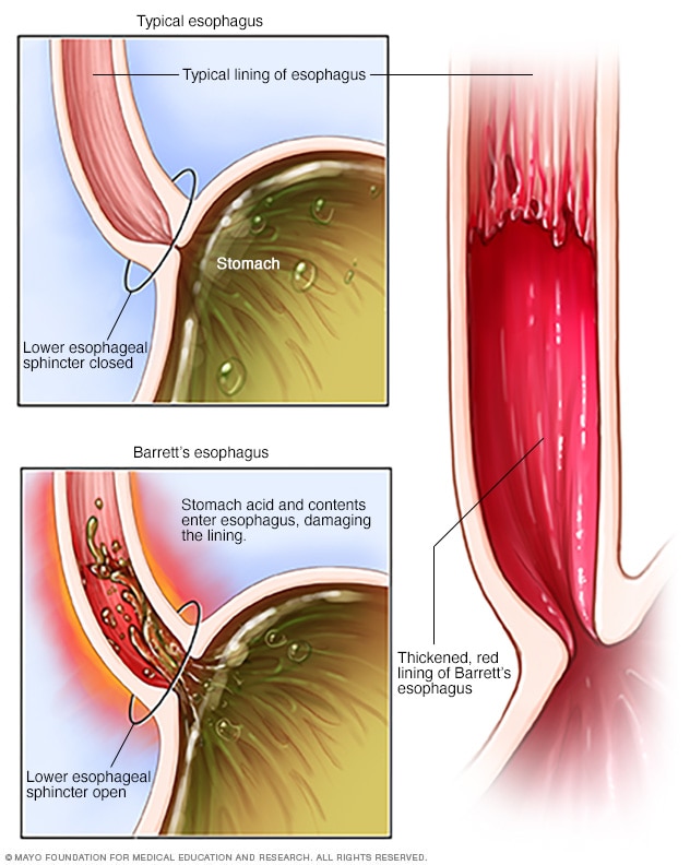 Barrett S Esophagus Symptoms And Causes Mayo Clinic