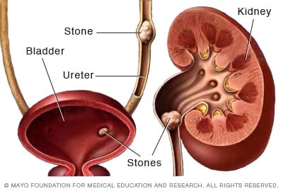 typical presentation of kidney stones