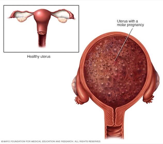 VERY GRAPHIC IMAGES. Uterine tissue or fetus?