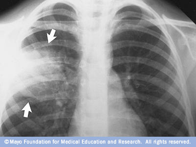 after effects of pneumonia on lungs