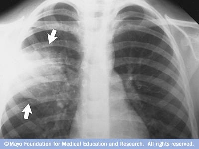 Chest X-Ray  American Heart Association