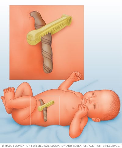 Umbilical Cord Care and Signs of Infection
