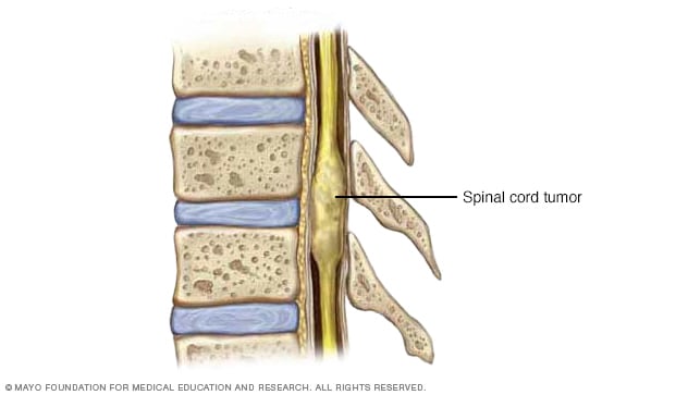 https://www.mayoclinic.org/-/media/kcms/gbs/patient-consumer/images/2013/08/26/10/04/ds00594_im00759_r7_spinalcordtumorthu_jpg.jpg