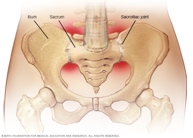 Sacroiliitis Symptoms And Causes Mayo Clinic