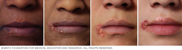 Cold Sore Symptoms And Causes Mayo Clinic