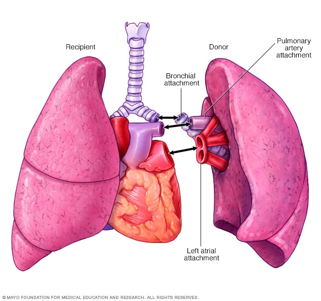 Lung transplant - Mayo Clinic
