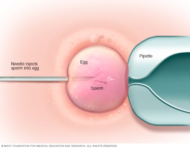 显示卵质内单精子注射（ICSI）的图示