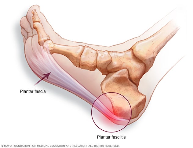 bottom of heel pain treatment