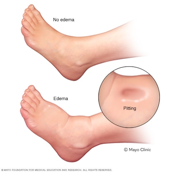 Edema - Symptoms and causes - Mayo Clinic