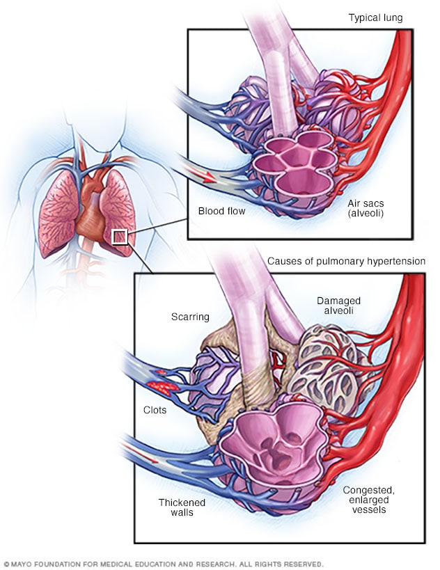 Pulmonary hypertension - Mayo Clinic