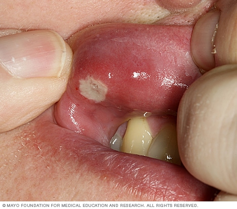 Canker sore - Symptoms and causes Mayo Clinic