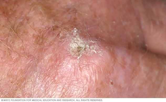 光化性角化病是一种皮肤上的鳞状粗糙斑块。