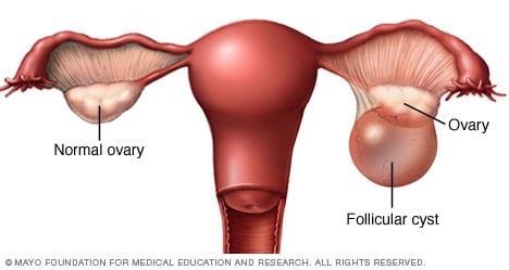 Ovarian cysts - Symptoms and causes - Mayo Clinic