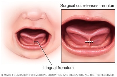 lingual frenulum sore